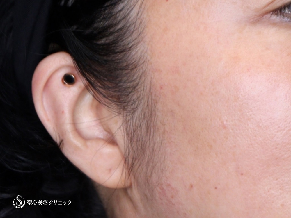 【40代女性・立ち耳にして小顔効果、可愛さアップ！！】立ち耳ヒアルロン酸（直後） After 