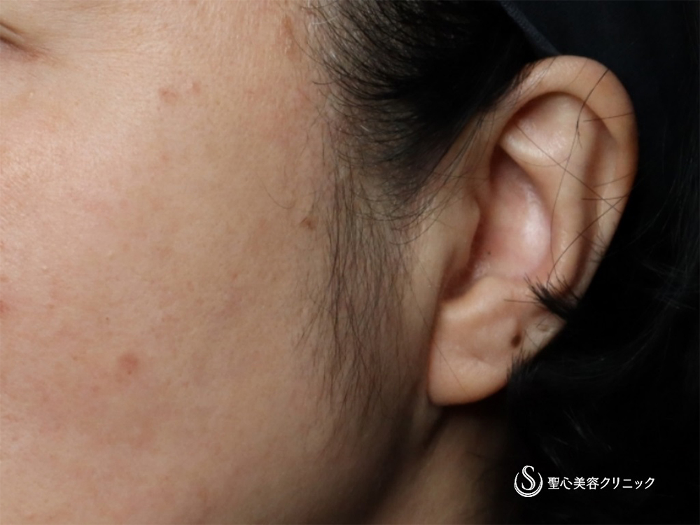 【40代女性・立ち耳にして小顔効果、可愛さアップ！！】立ち耳ヒアルロン酸（直後） Before 