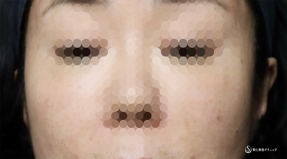【40代女性・立ち耳にして小顔効果、可愛さアップ！！】立ち耳ヒアルロン酸（直後） Before 