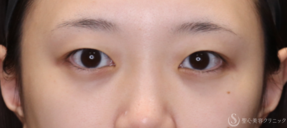 【20代女性・切開法でわずかな左右差を整える】二重術（切開法）（1ヶ月後） Before 