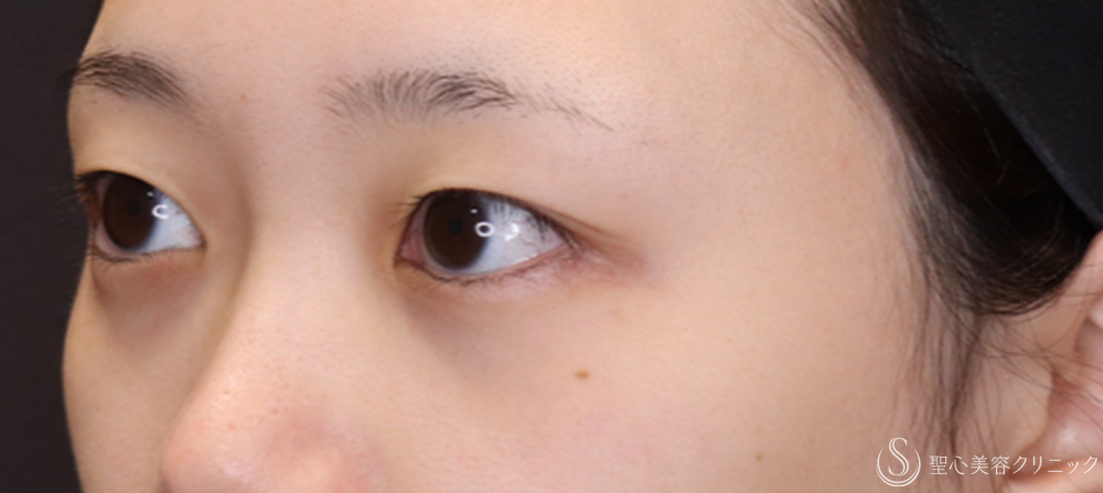 【20代女性・切開法でわずかな左右差を整える】二重術（切開法）（1ヶ月後） Before 