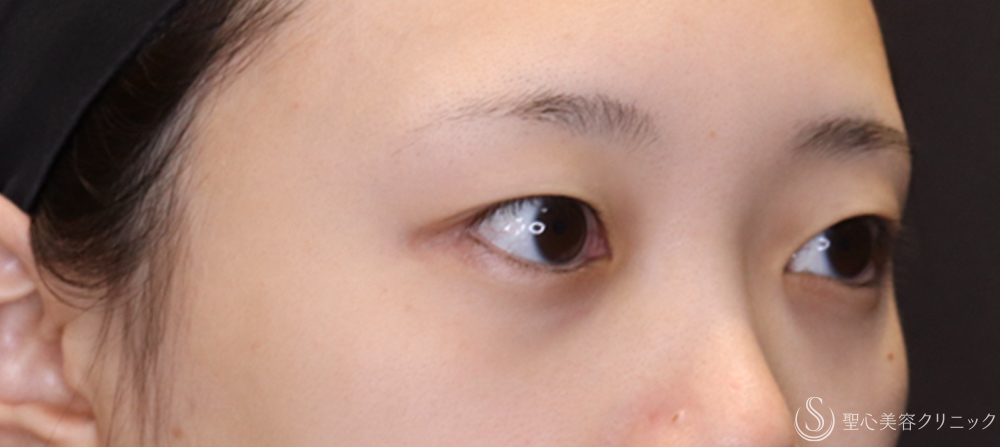 【20代女性・切開法でわずかな左右差を整える】二重術（切開法）（1ヶ月後） Before 