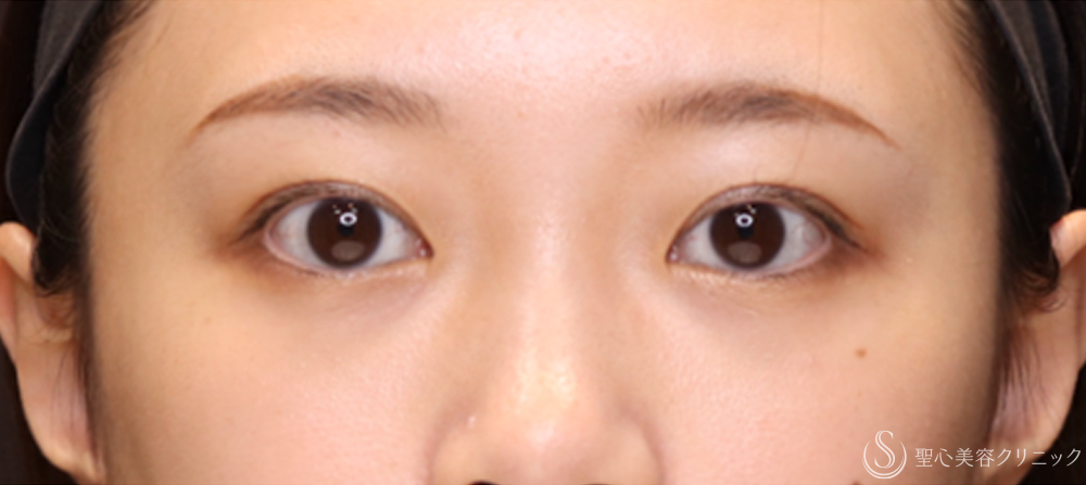 【20代女性・切開法でわずかな左右差を整える】二重術（切開法）（1ヶ月後） After 