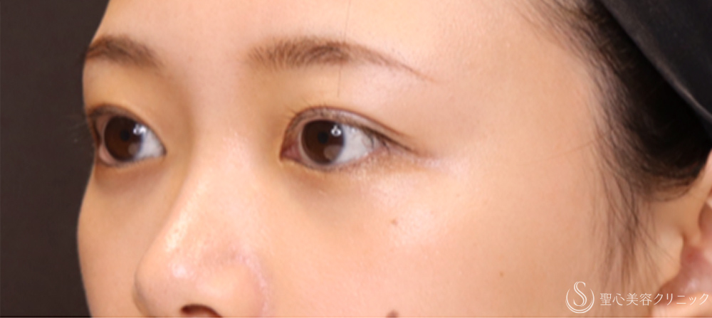【20代女性・切開法でわずかな左右差を整える】二重術（切開法）（1ヶ月後） After 
