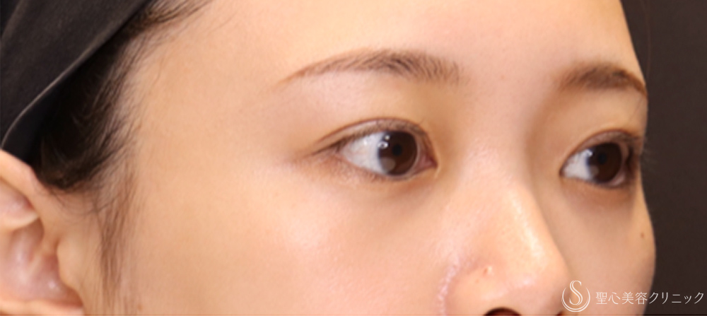【20代女性・切開法でわずかな左右差を整える】二重術（切開法）（1ヶ月後） After 