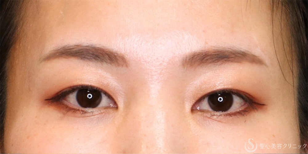 【30代女性・まぶたスッキリ】眉下切開+目上切開（1ヶ月後） Before 