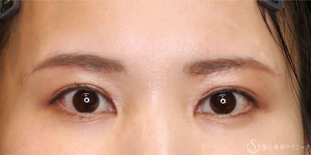 【30代女性・まぶたスッキリ】眉下切開+目上切開（1ヶ月後） After 