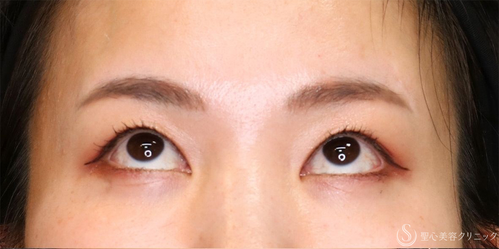 【30代女性・まぶたスッキリ】眉下切開+目上切開（1ヶ月後） Before 