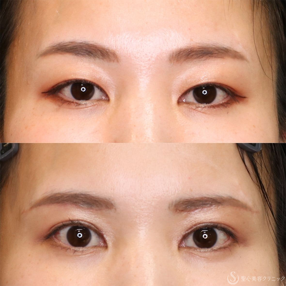 【30代女性・まぶたスッキリ】眉下切開+目上切開（1ヶ月後） After 名古屋・ぱっちり二重・平行型二重