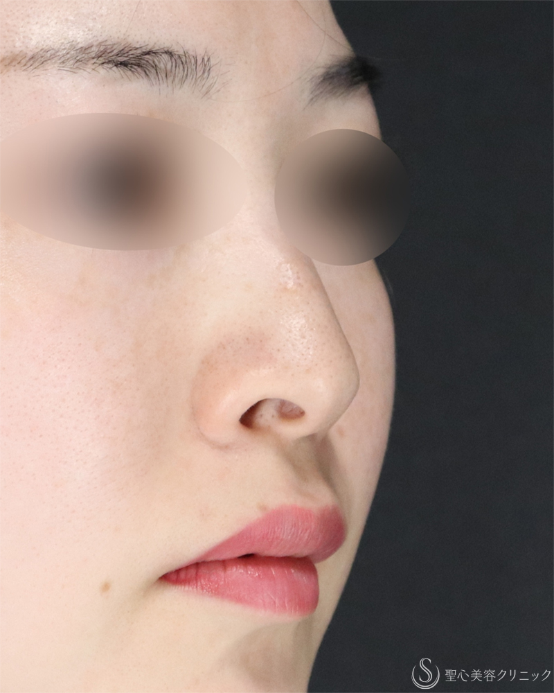 【20代女性・小鼻縮小術できれいな忘れ鼻に】小鼻縮小術（外側法）（術後1ヶ月） Before 
