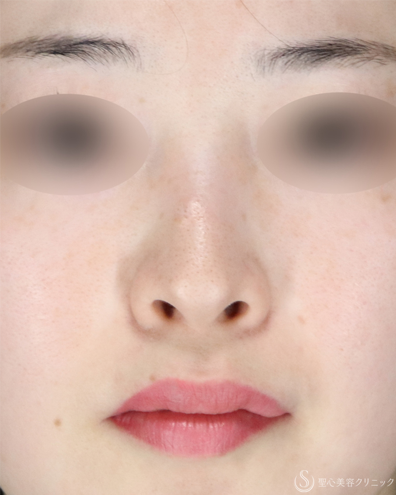 【20代女性・小鼻縮小術できれいな忘れ鼻に】小鼻縮小術（外側法）（術後1ヶ月） Before 