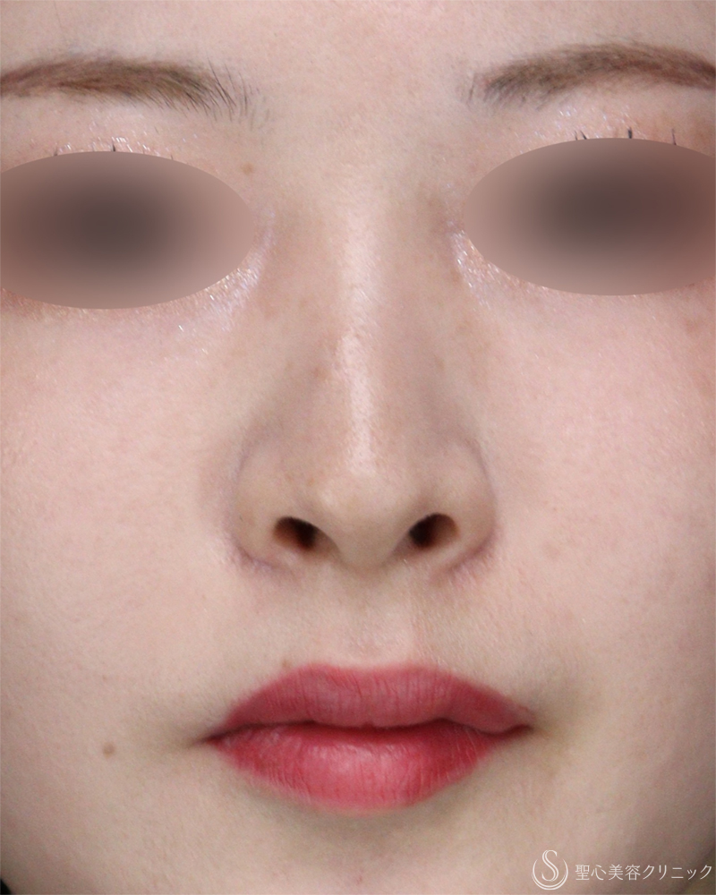 【20代女性・小鼻縮小術できれいな忘れ鼻に】小鼻縮小術（外側法）（術後1ヶ月） After 