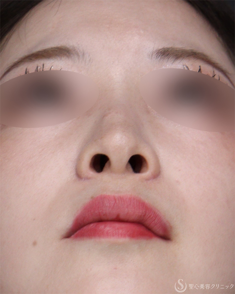 【20代女性・小鼻縮小術できれいな忘れ鼻に】小鼻縮小術（外側法）（術後1ヶ月） After 