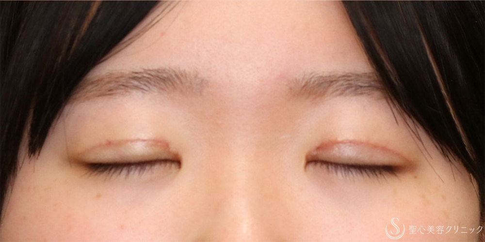 【10代女性・自然な二重に】二重全切開術＋脂肪取り＋目上切開（1ヶ月後・3ヶ月後） After 