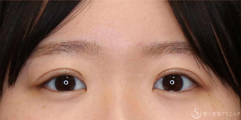 【10代女性・自然な二重に】二重全切開術＋脂肪取り＋目上切開（1ヶ月後・3ヶ月後） After 