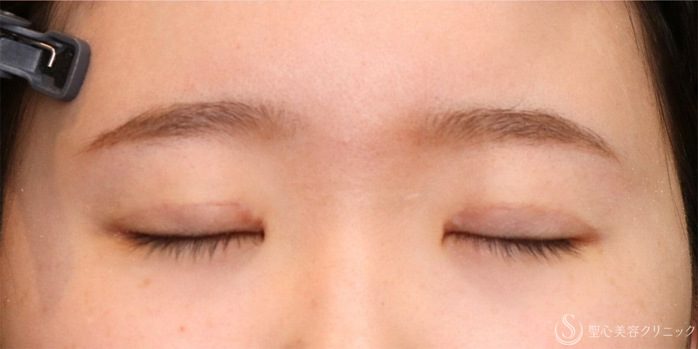 【10代女性・自然な二重に】二重全切開術＋脂肪取り＋目上切開（1ヶ月後・3ヶ月後） After 