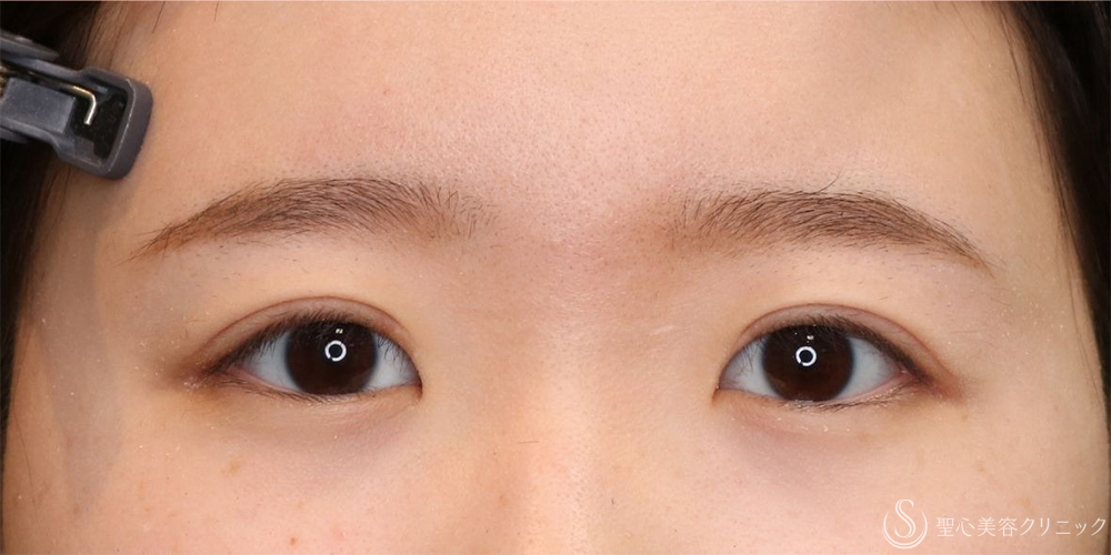【10代女性・自然な二重に】二重全切開術＋脂肪取り＋目上切開（1ヶ月後・3ヶ月後） After 