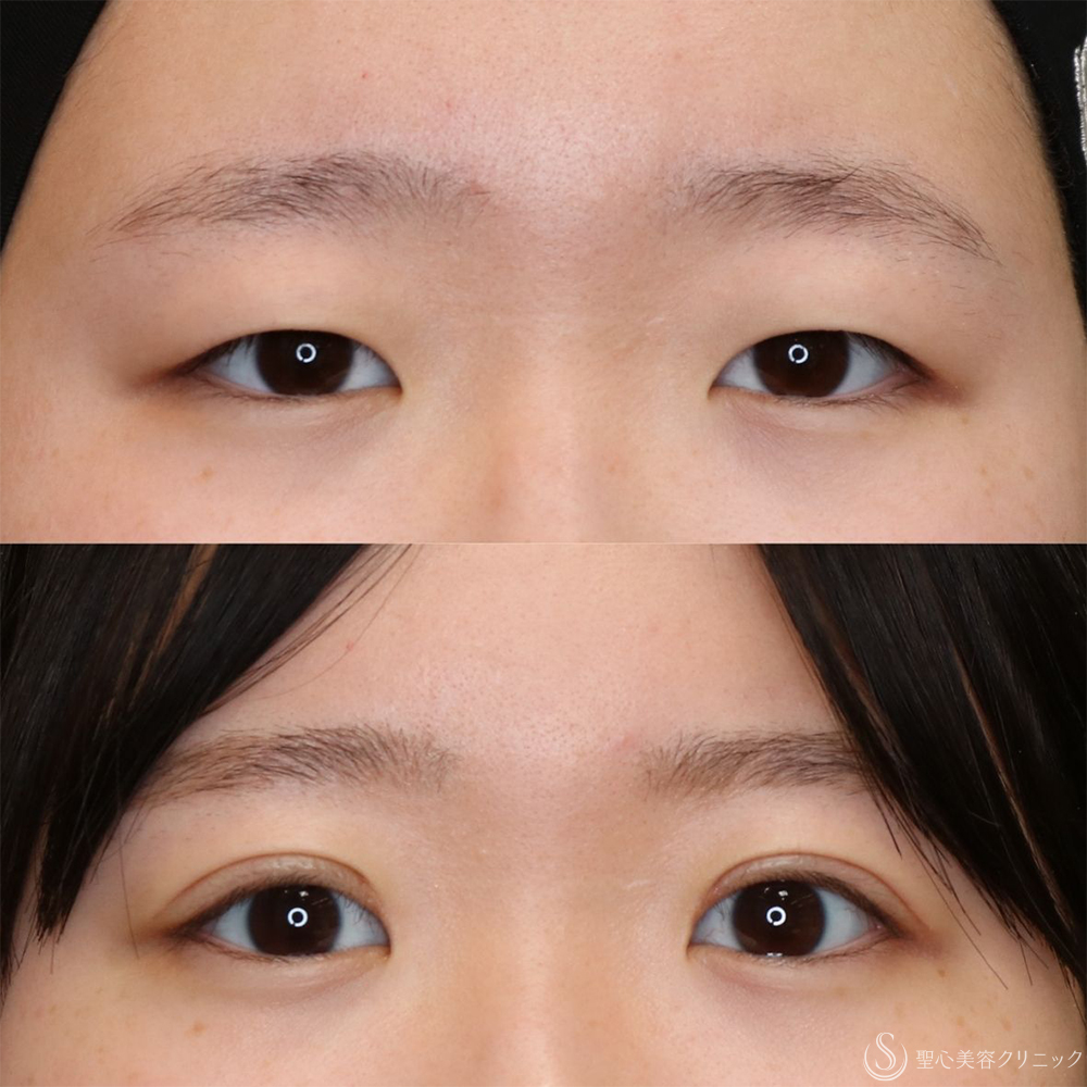 【10代女性・自然な二重に】二重全切開術＋脂肪取り＋目上切開（1ヶ月後・3ヶ月後） After 平行型二重・パッチリ二重・二重