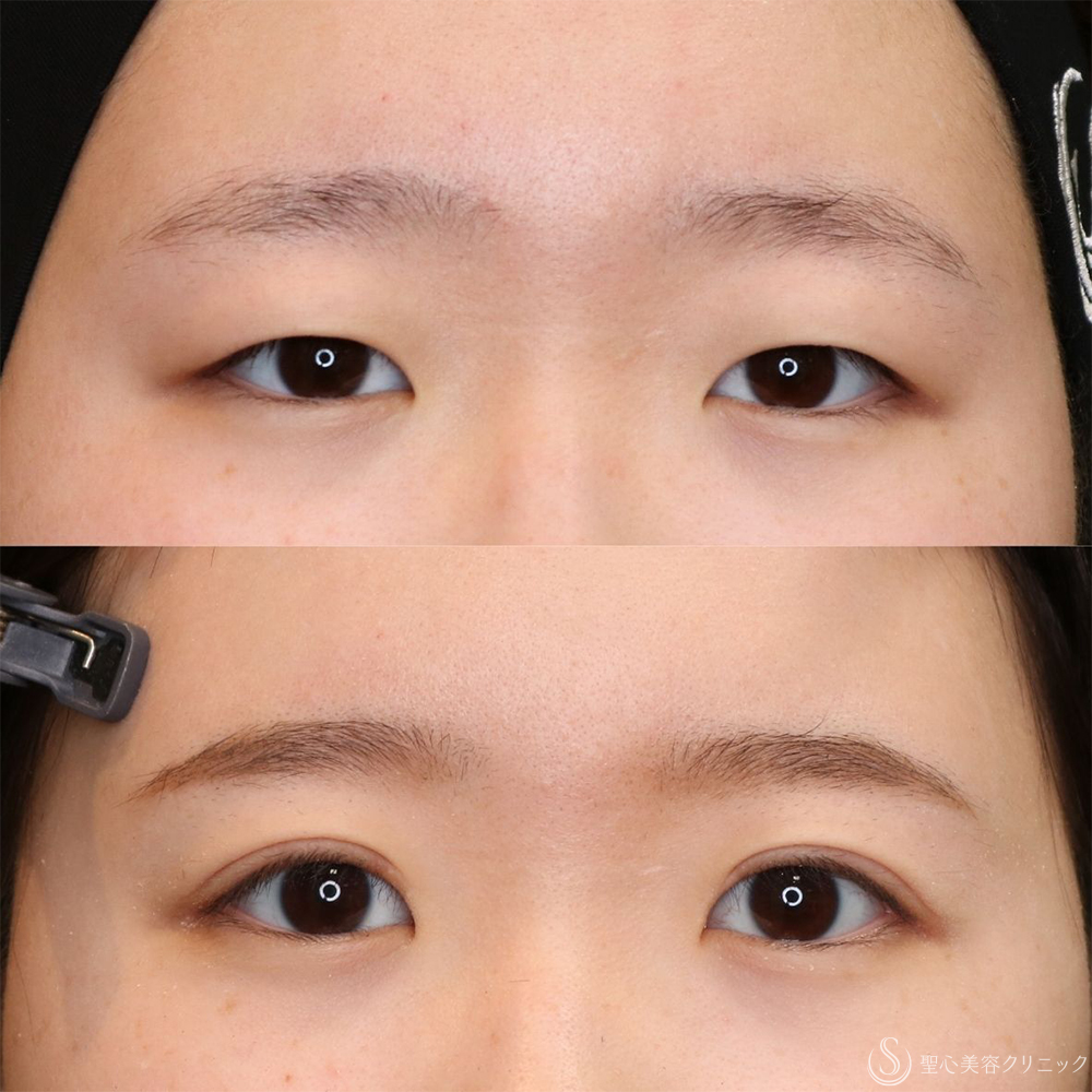 【10代女性・自然な二重に】二重全切開術＋脂肪取り＋目上切開（1ヶ月後・3ヶ月後） After 平行型二重・パッチリ二重・二重