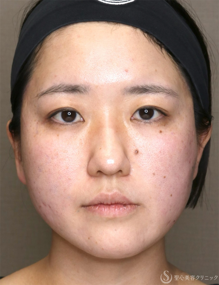 【30代女性・リフトアップとともに、左右差を整える】糸リフト（PDOスレッドリフト）（直後） After 