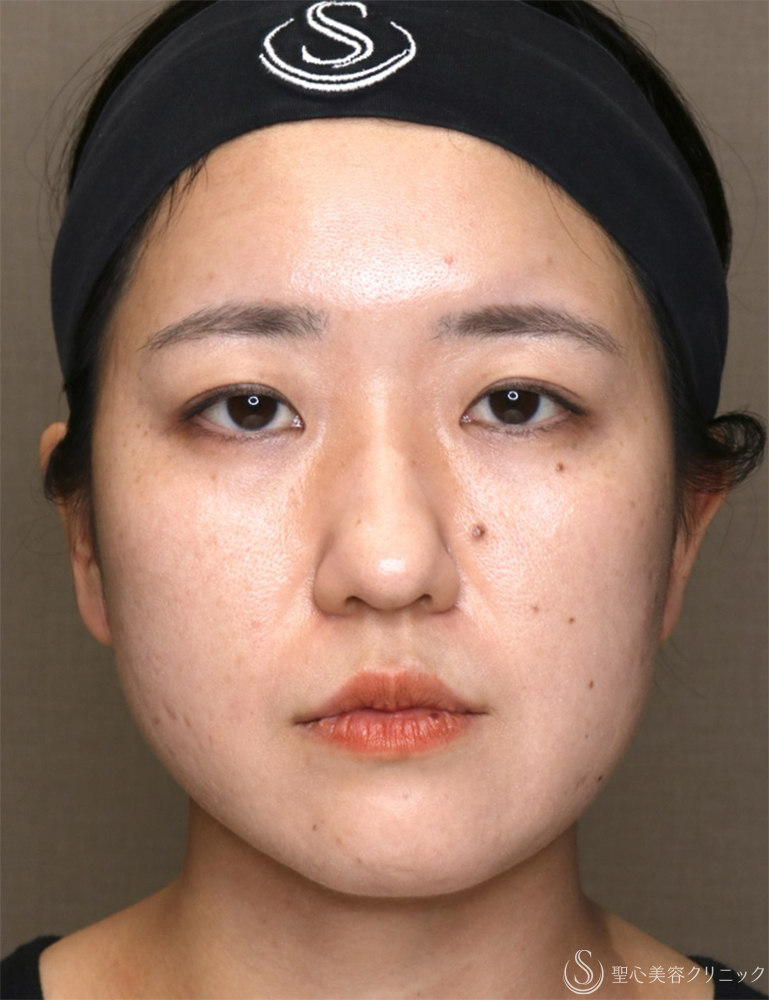 【30代女性・リフトアップとともに、左右差を整える】糸リフト（PDOスレッドリフト）（直後） Before 