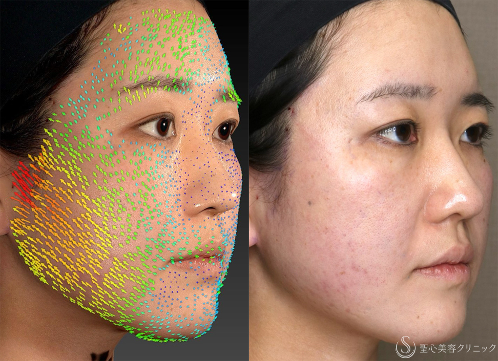 【30代女性・リフトアップとともに、左右差を整える】糸リフト（PDOスレッドリフト）（直後） After 