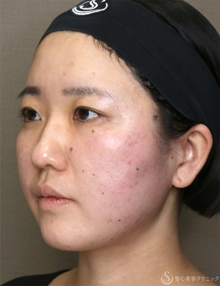 【30代女性・リフトアップとともに、左右差を整える】糸リフト（PDOスレッドリフト）（直後） After 