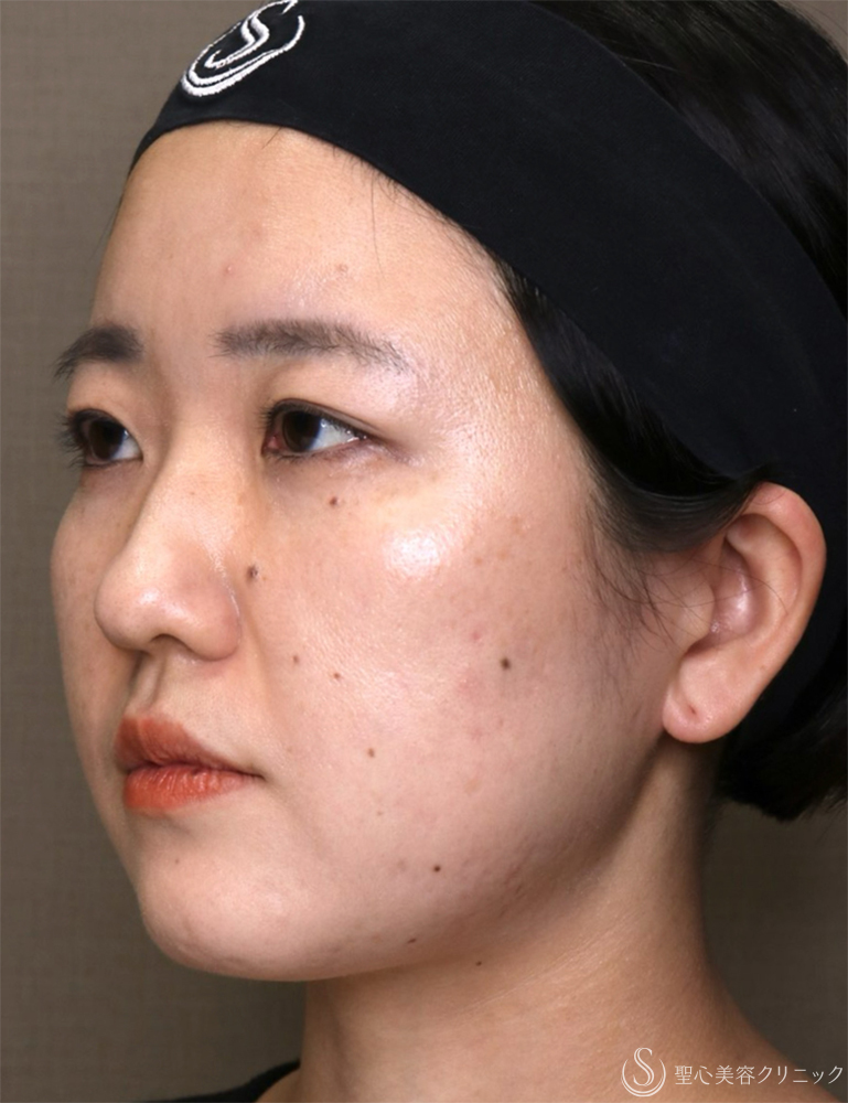 【30代女性・リフトアップとともに、左右差を整える】糸リフト（PDOスレッドリフト）（直後） Before 