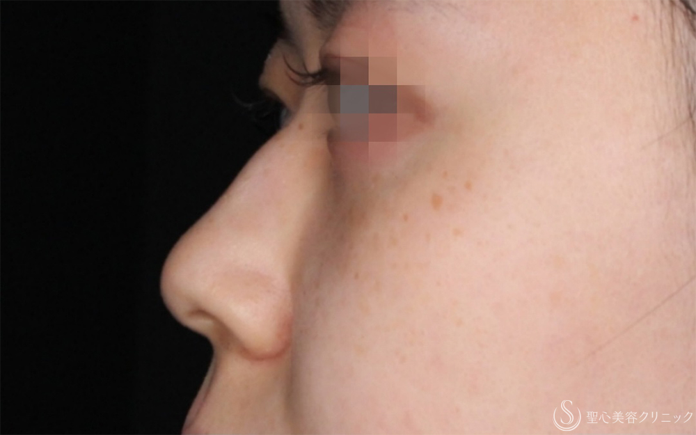 【20代女性・自然に整う、“ちょうどいい鼻”】鷲鼻修正＋鼻尖形成＋耳介軟骨移植（術後1ヶ月） Before 