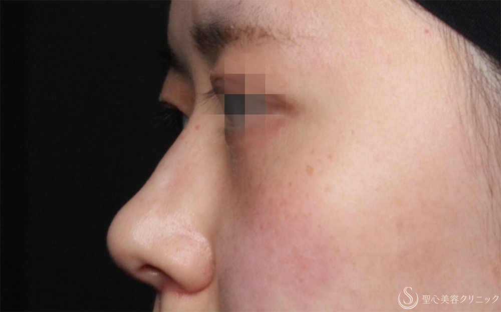 【20代女性・自然に整う、“ちょうどいい鼻”】鷲鼻修正＋鼻尖形成＋耳介軟骨移植（術後1ヶ月） After 