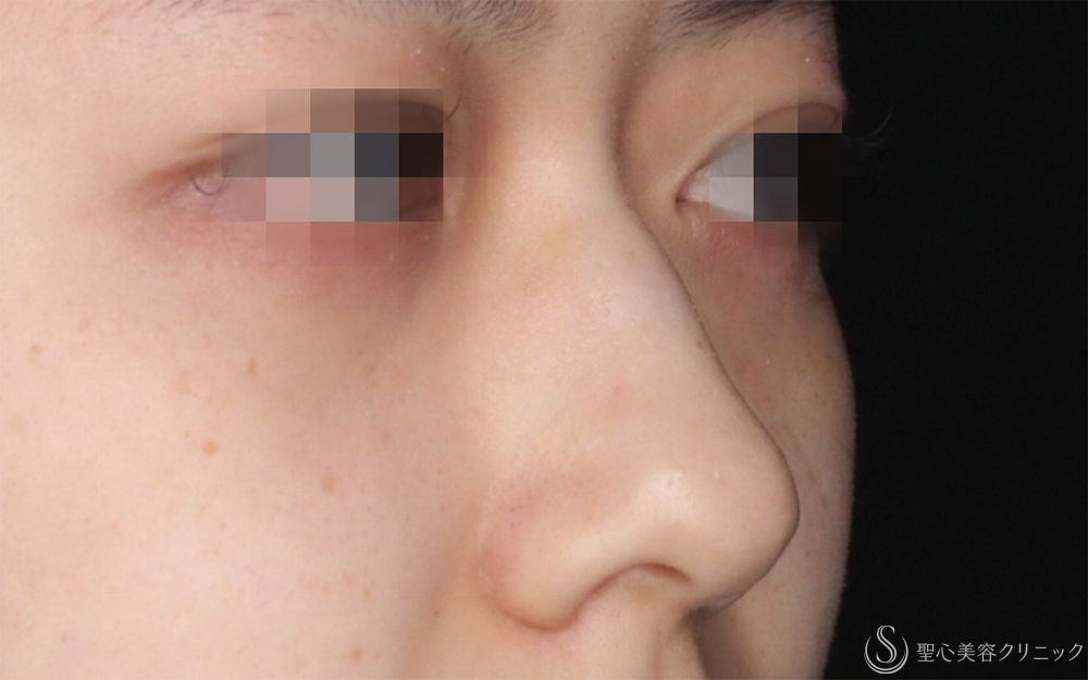 【20代女性・自然に整う、“ちょうどいい鼻”】鷲鼻修正＋鼻尖形成＋耳介軟骨移植（術後1ヶ月） Before 