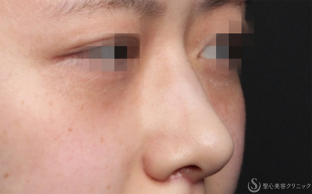 【20代女性・自然に整う、“ちょうどいい鼻”】鷲鼻修正＋鼻尖形成＋耳介軟骨移植（術後1ヶ月） After 