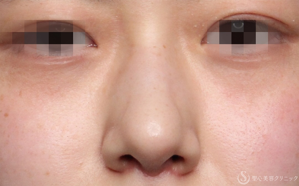 【20代女性・自然に整う、“ちょうどいい鼻”】鷲鼻修正＋鼻尖形成＋耳介軟骨移植（術後1ヶ月） After 