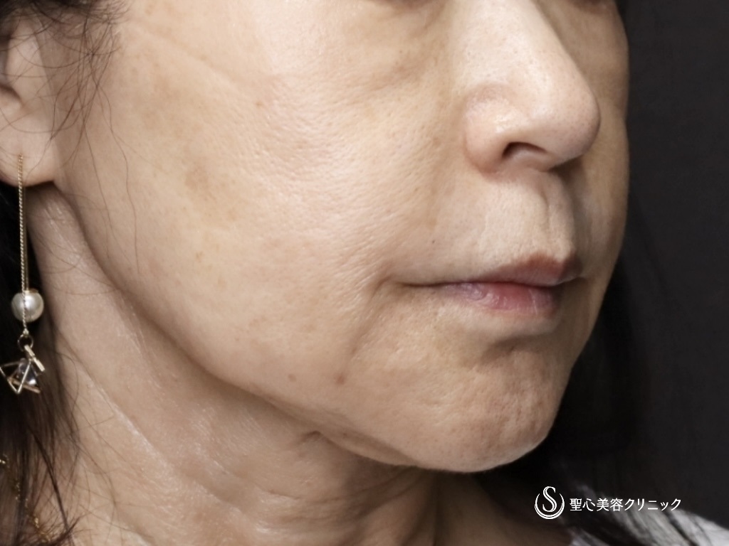 【60代女性・なんと注射の治療だけで11年前よりも若々しい！！】プレミアムPRP皮膚再生療法（11年後） After 