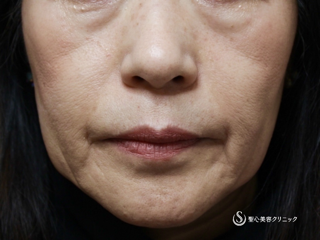 【60代女性・なんと注射の治療だけで11年前よりも若々しい！！】プレミアムPRP皮膚再生療法（11年後） Before 