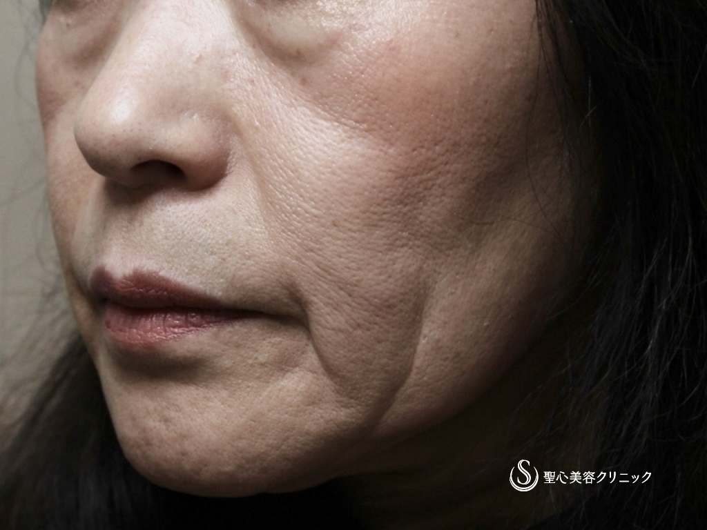 【60代女性・なんと注射の治療だけで11年前よりも若々しい！！】プレミアムPRP皮膚再生療法（11年後） Before 