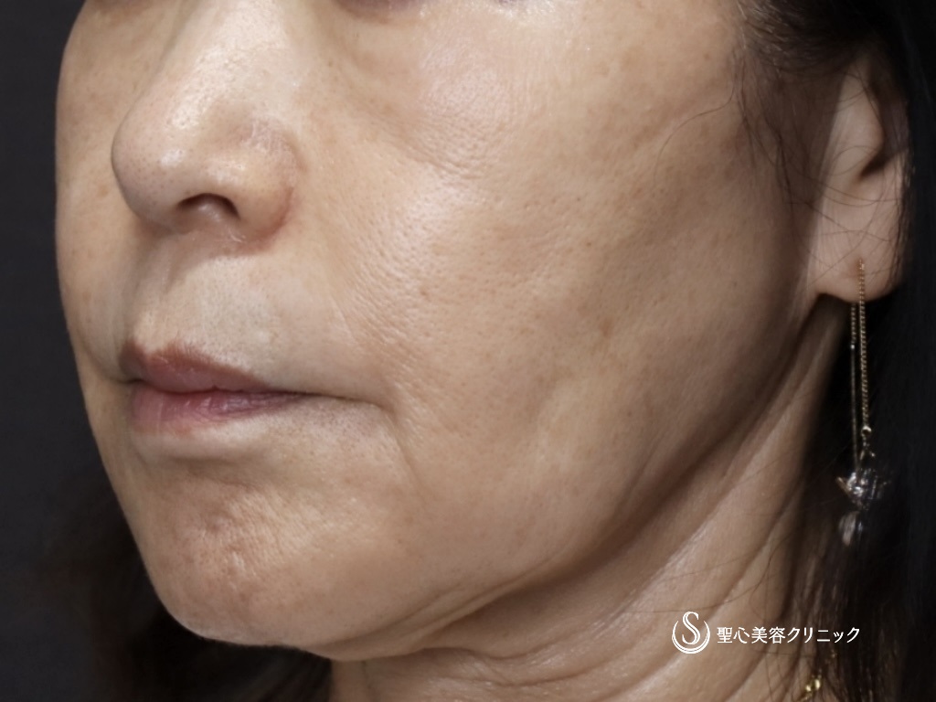 【60代女性・なんと注射の治療だけで11年前よりも若々しい！！】プレミアムPRP皮膚再生療法（11年後） After 