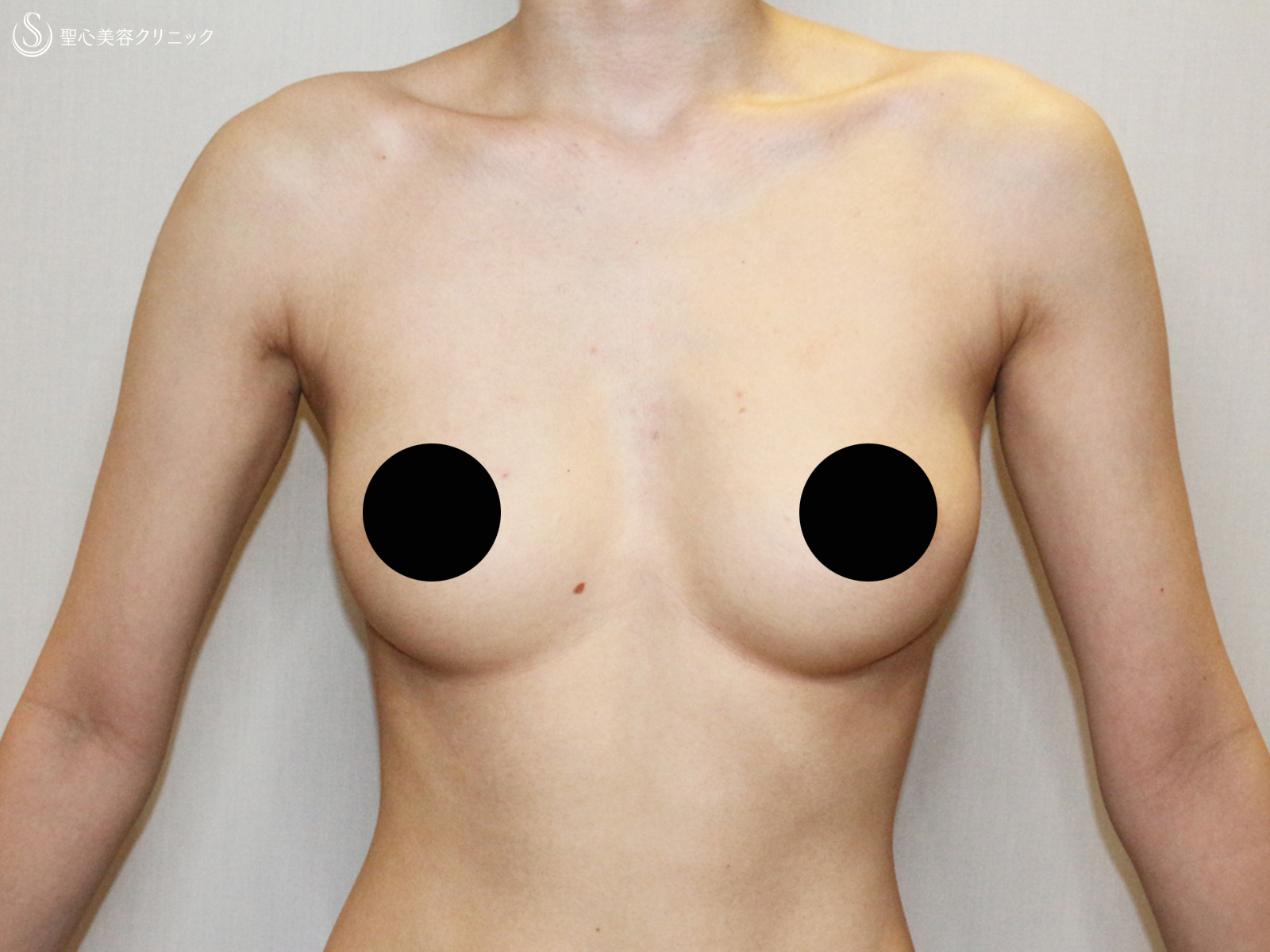 【20代FTM・「性同一性障害」男らしい胸に】乳腺切除＋脂肪吸引（術直後〜9ヶ月後） Before 