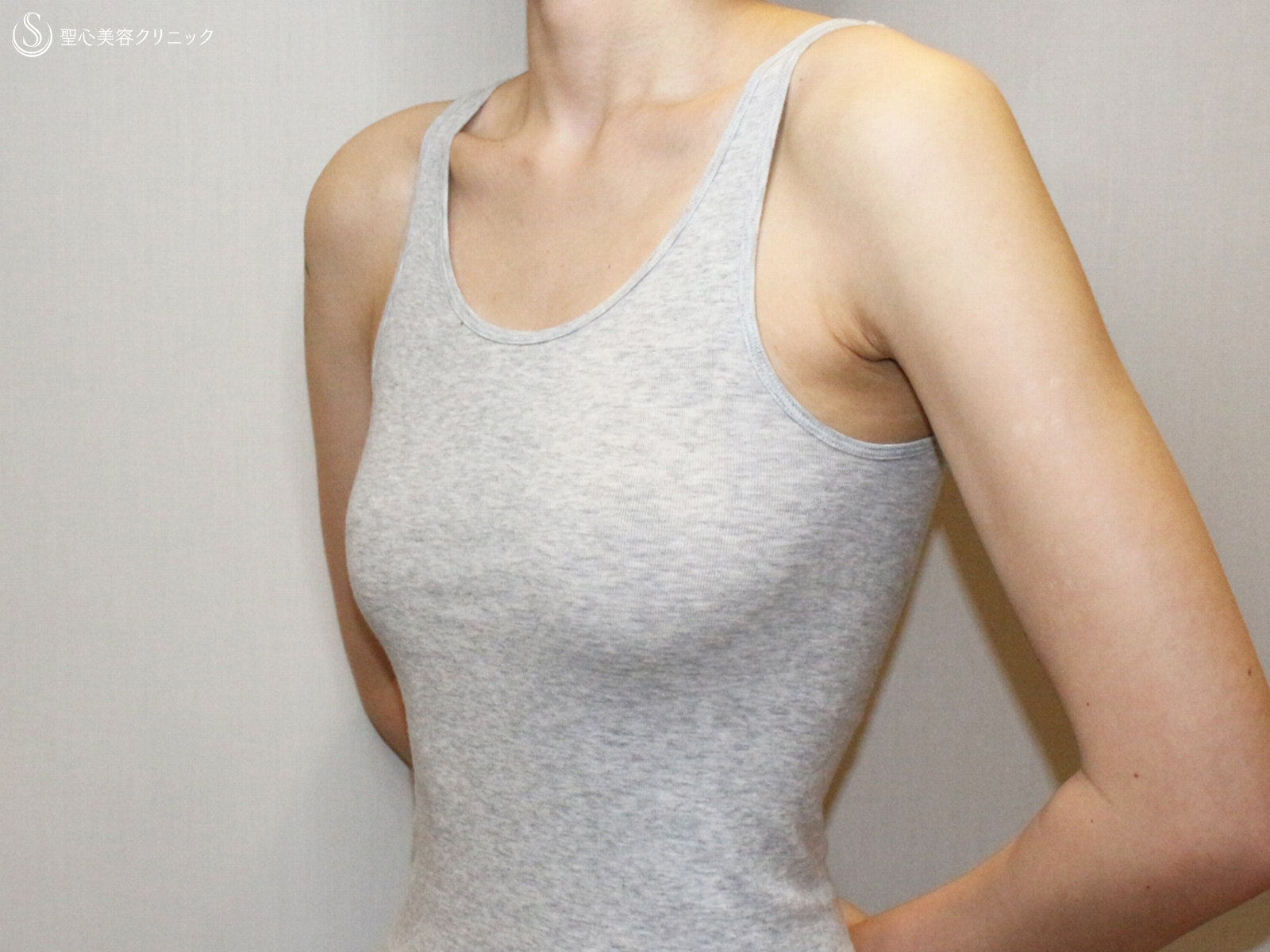 【20代FTM・「性同一性障害」男らしい胸に】乳腺切除＋脂肪吸引（術直後〜9ヶ月後） Before 