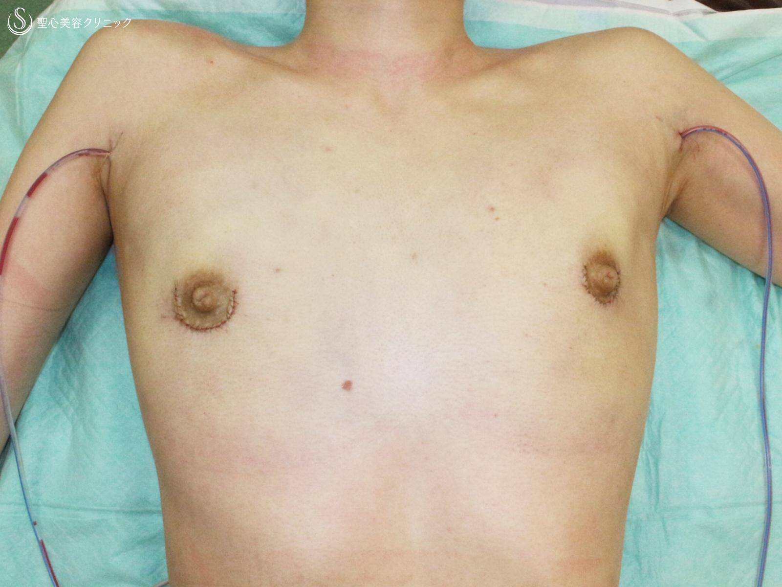 【20代FTM・「性同一性障害」男らしい胸に】乳腺切除＋脂肪吸引（術直後〜9ヶ月後） Before 