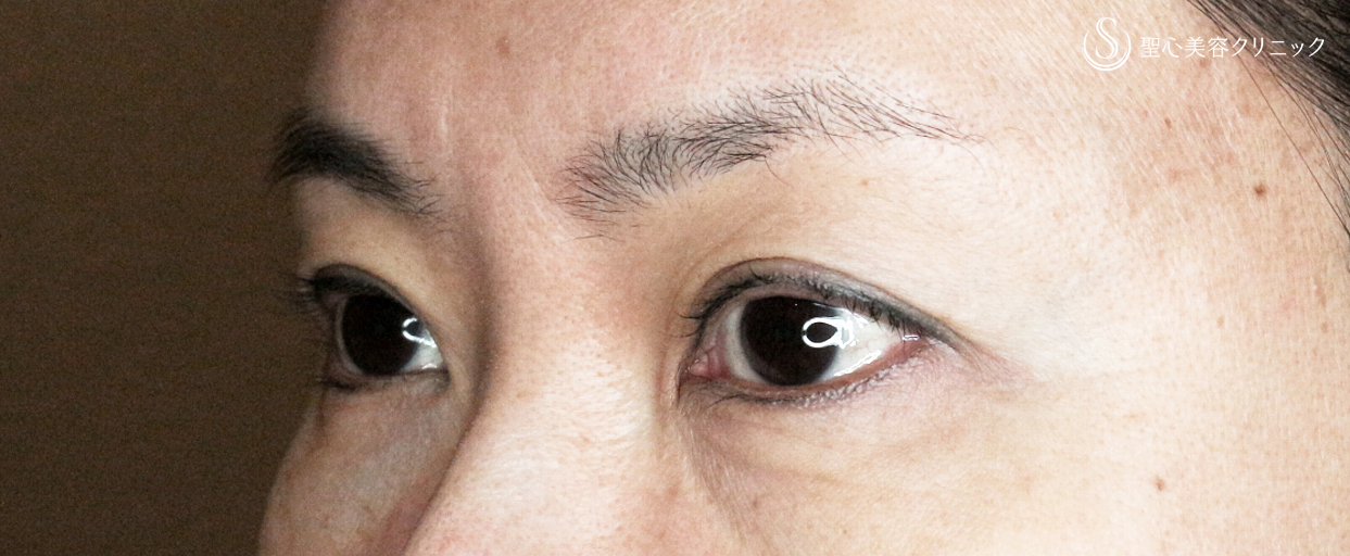 【50代女性・20年前の二重ラインに若返る】眉下リフト+α「Ver.1」単独（術直後〜2年後） After 