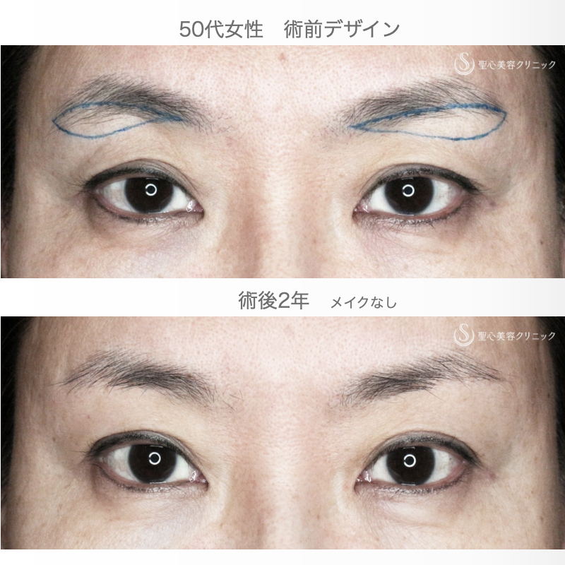 【50代女性・20年前の二重ラインに若返る】眉下リフト+α「Ver.1」単独（術直後〜2年後） After 