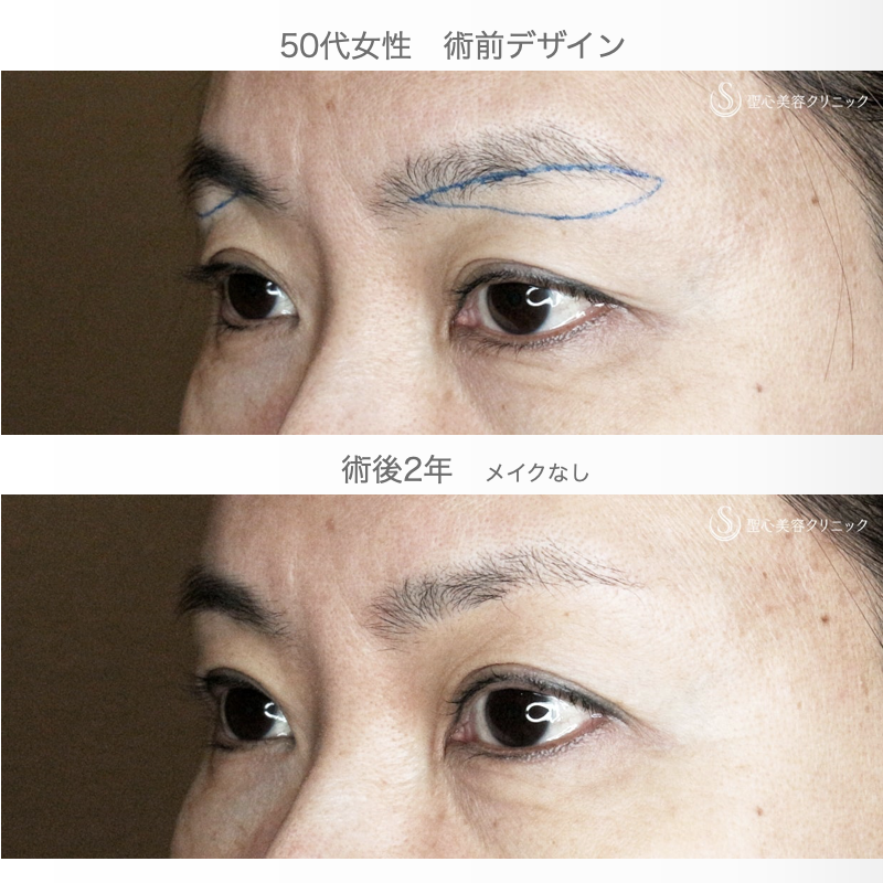 【50代女性・20年前の二重ラインに若返る】眉下リフト+α「Ver.1」単独（術直後〜2年後） After 
