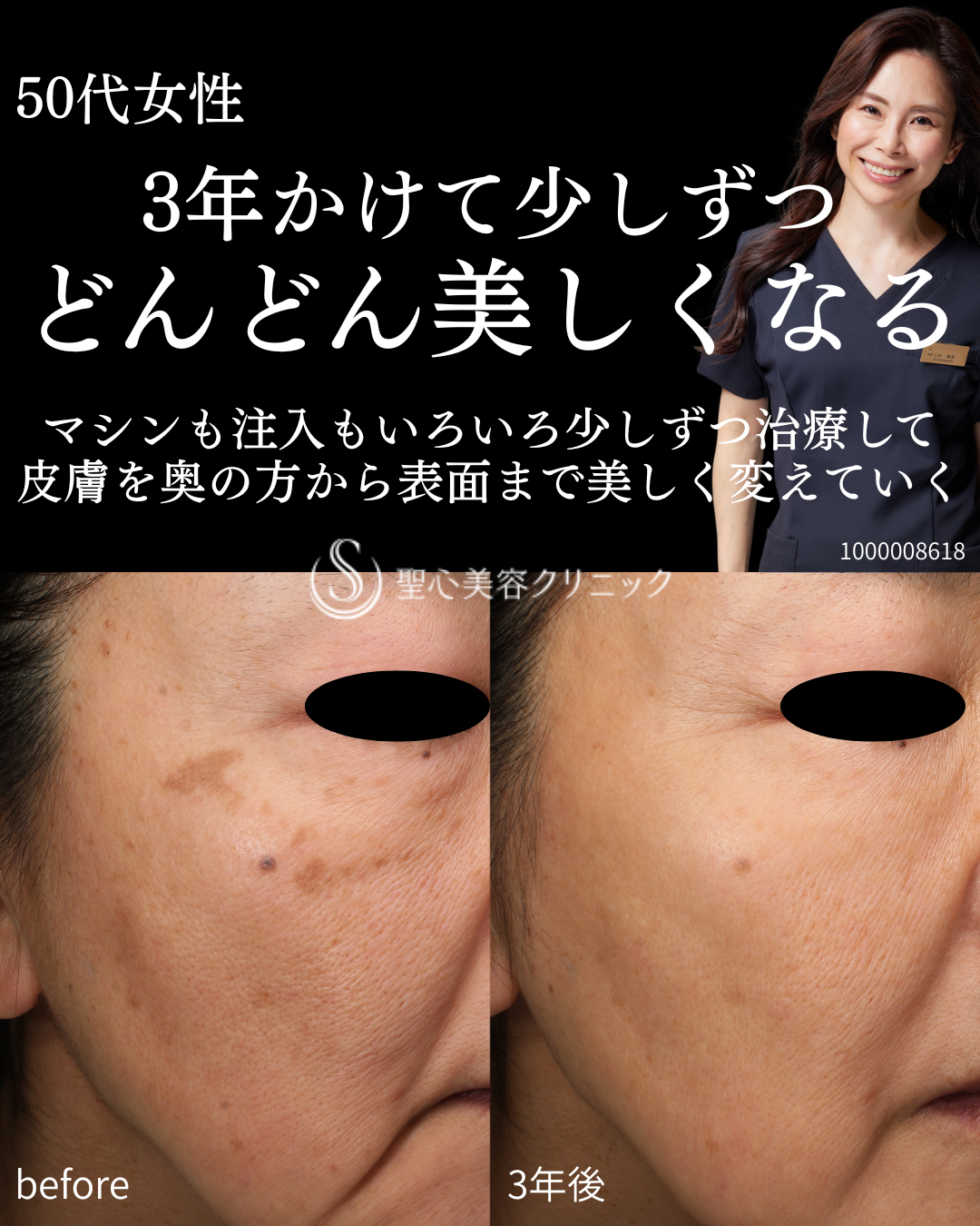 【50代女性・肌全体の若返り3年間で少しずつ治療】プレミアムPRP＋セレックV＋デンシティ＋ボトックスリフト（3年後） After 