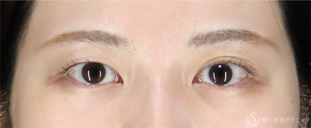 【20代女性・埋没法で左右差のない二重】二重術（埋没法、右眼のみ）マイクロメソッド＋α（2ヶ月後） Before 