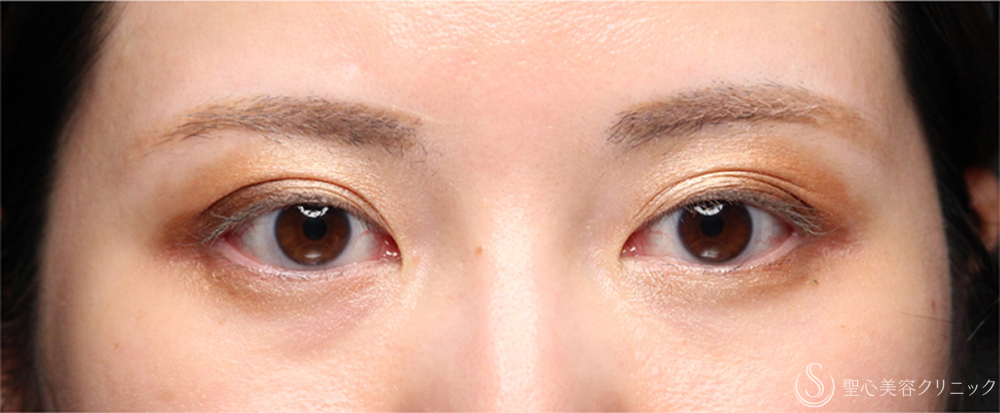 【20代女性・埋没法で左右差のない二重】二重術（埋没法、右眼のみ）マイクロメソッド＋α（2ヶ月後） After 