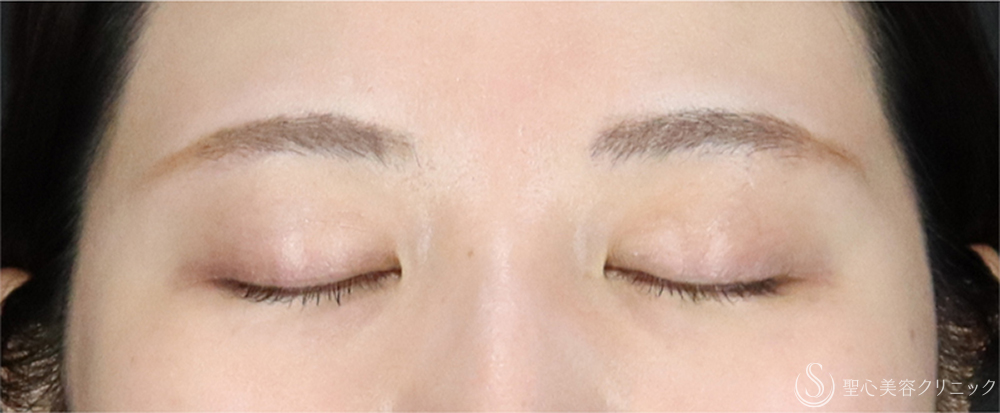 【20代女性・埋没法で左右差のない二重】二重術（埋没法、右眼のみ）マイクロメソッド＋α（2ヶ月後） Before 