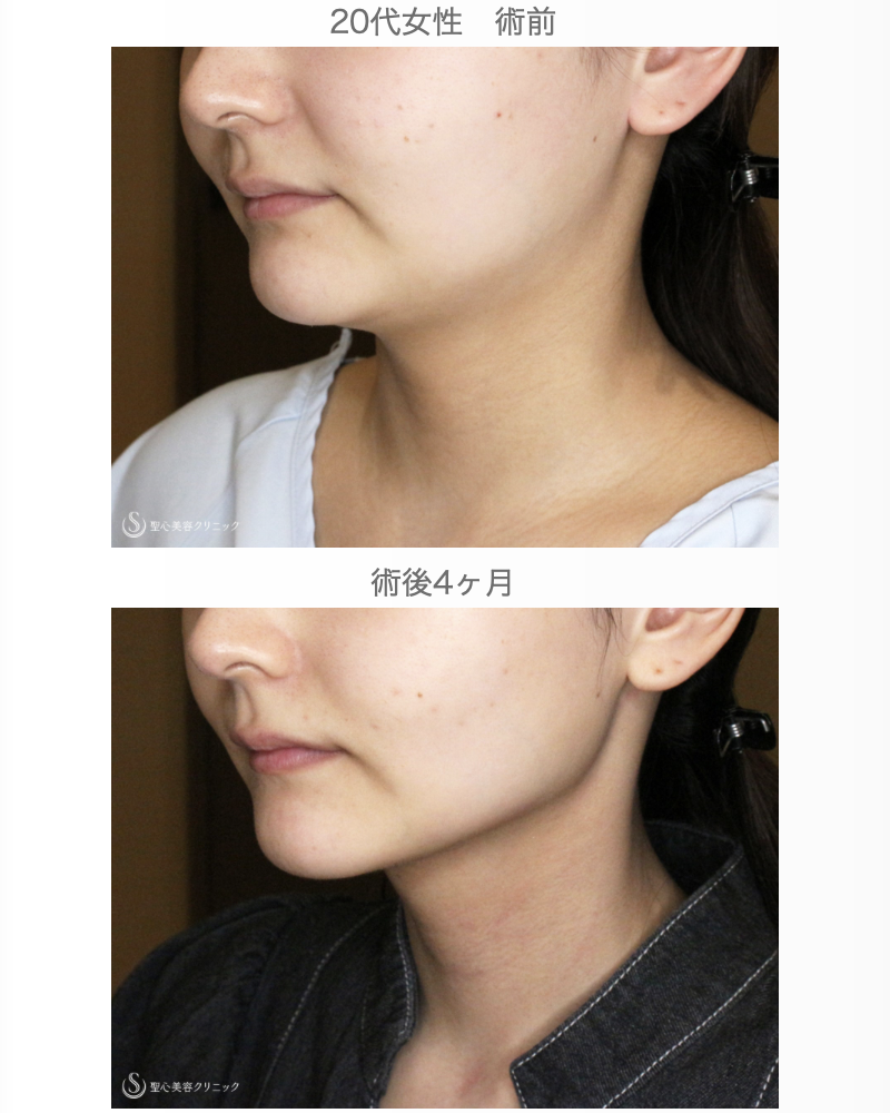 【20代女性・フェイスライン劇的変化】あご下の脂肪吸引注射（直後〜4ヶ月後） After 