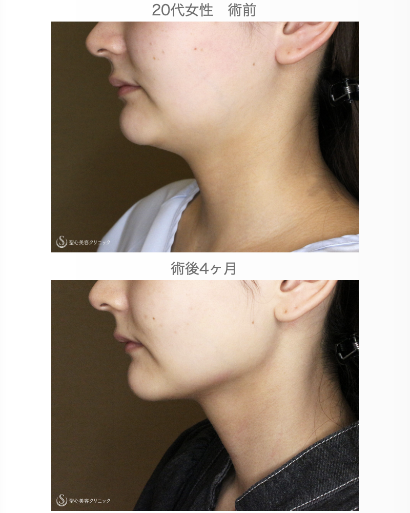 【20代女性・フェイスライン劇的変化】あご下の脂肪吸引注射（直後〜4ヶ月後） After 