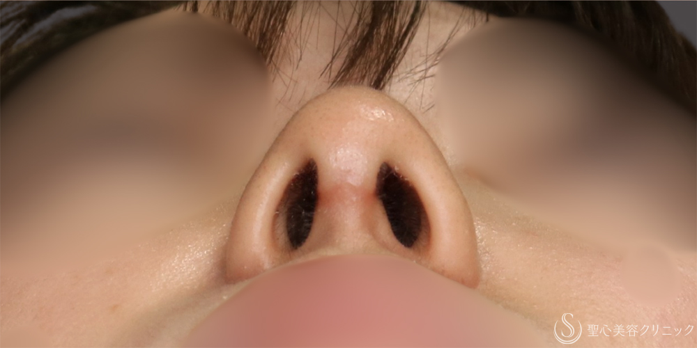 【20代女性・アップノーズを改善】鼻尖縮小（ストラット法）＋耳介軟骨移植（1ヶ月後） After 